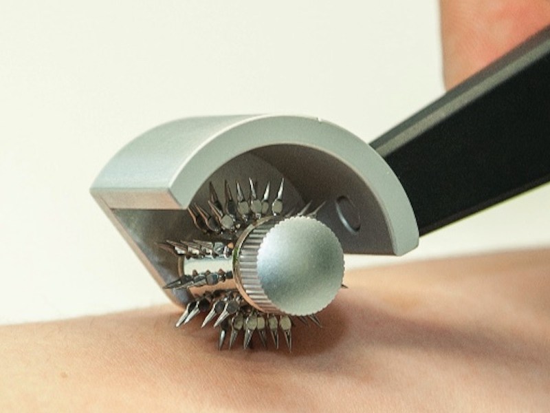 Baunscheidt Verfahren